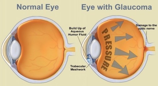 GlaucomaEye