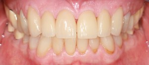 Teeth_after